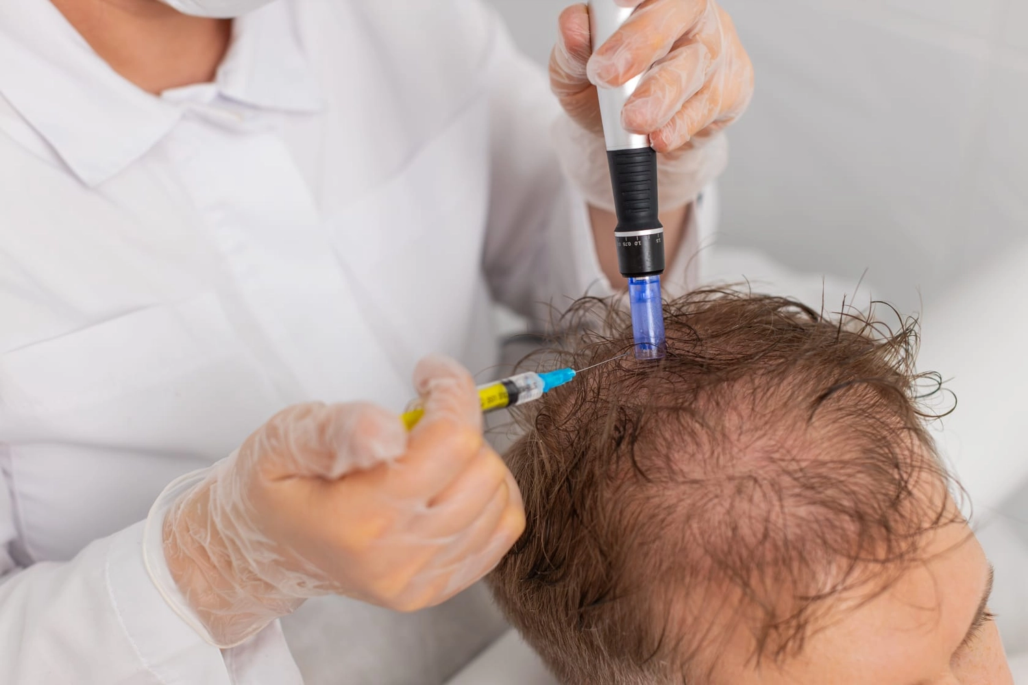 IMMER JITSI You are Beauty – Kosmetikstudio – Microneedling-Behandlung gegen Haarausfall – Haarwachstum